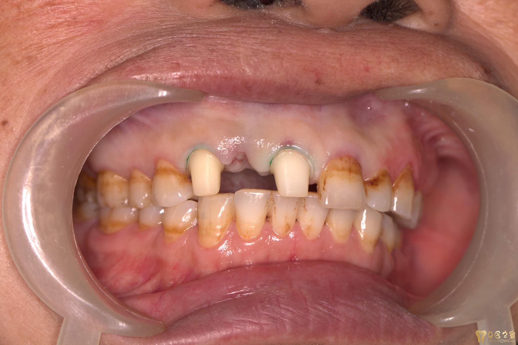 钢托排牙tinh thao lap - 活动区 - 牙匠之家 - powered by discuz!