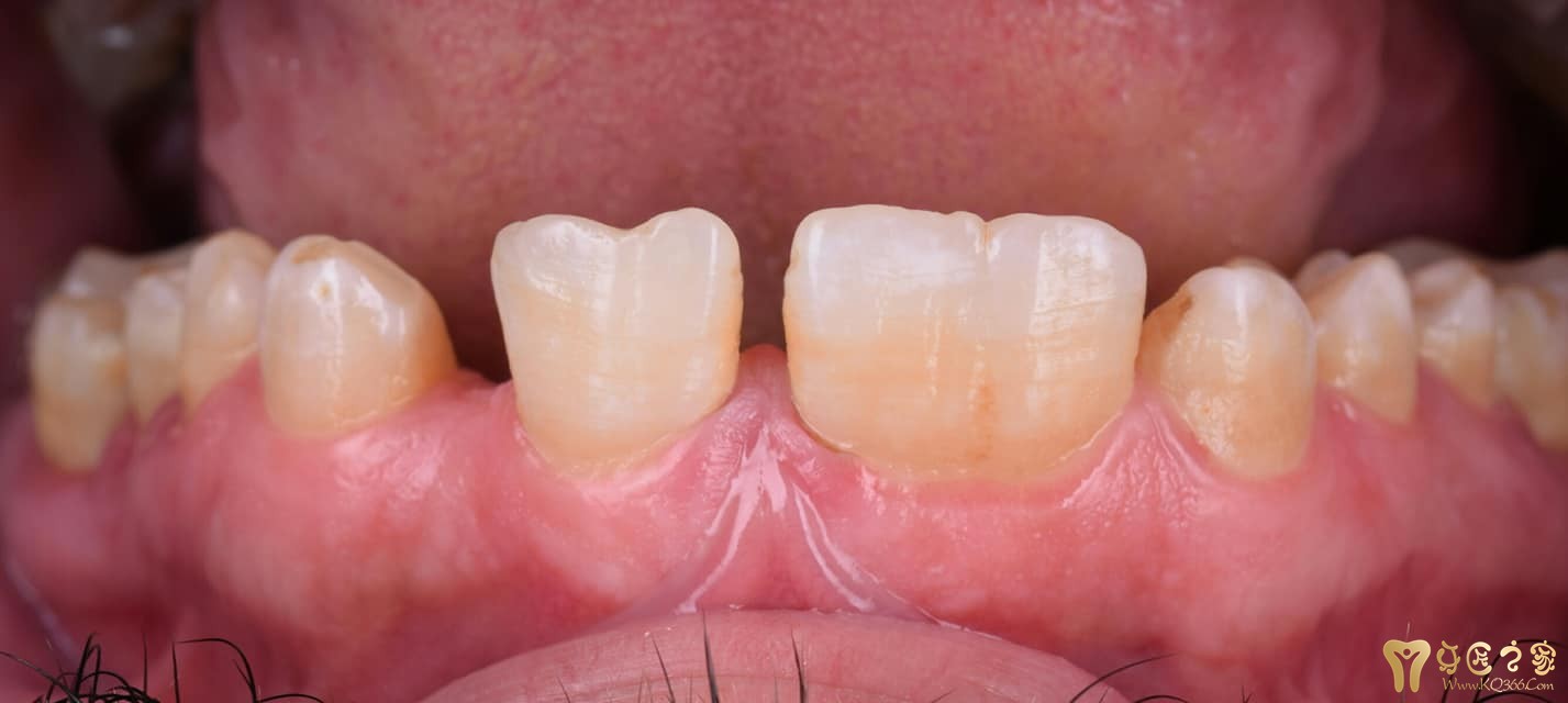 胶托排牙tpd ale raymundo - 活动区 - 牙匠之家 - powered by discuz