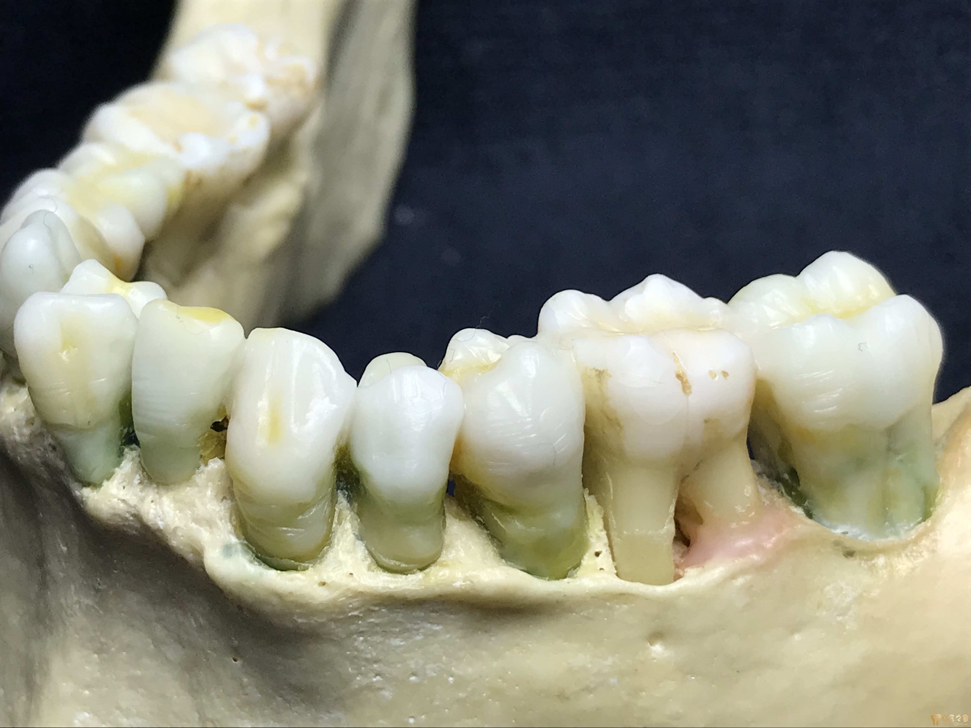 原创专区更多作品种植专区更多作品3shape金属内冠缺失位的牙齿有没有